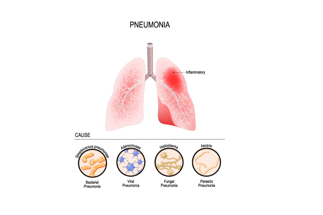肺炎が起こるメカニズム