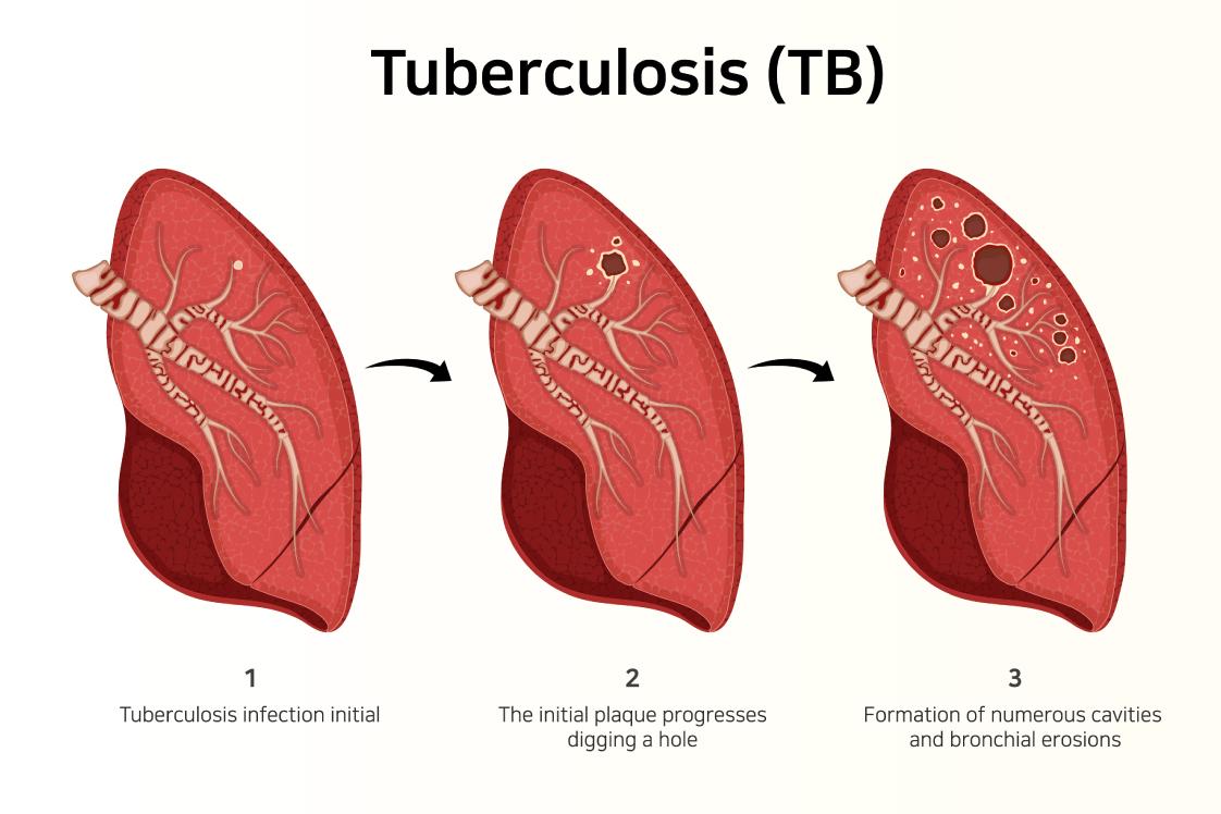 肺結核が発症するメカニズム