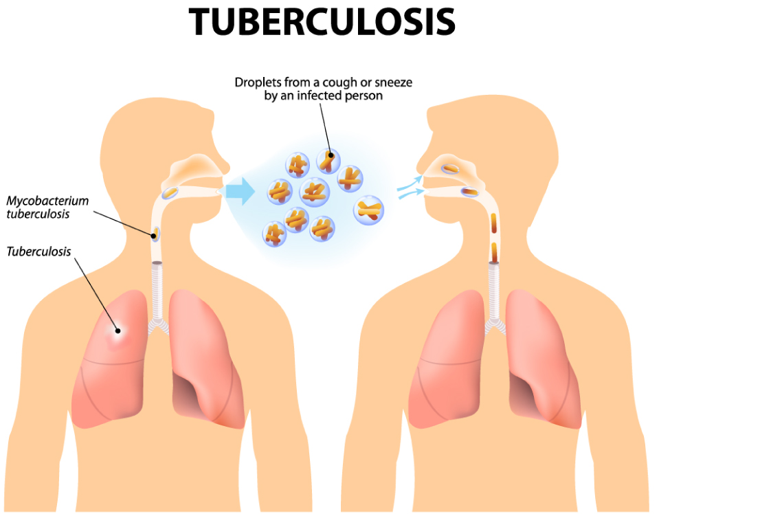 結核菌による感染