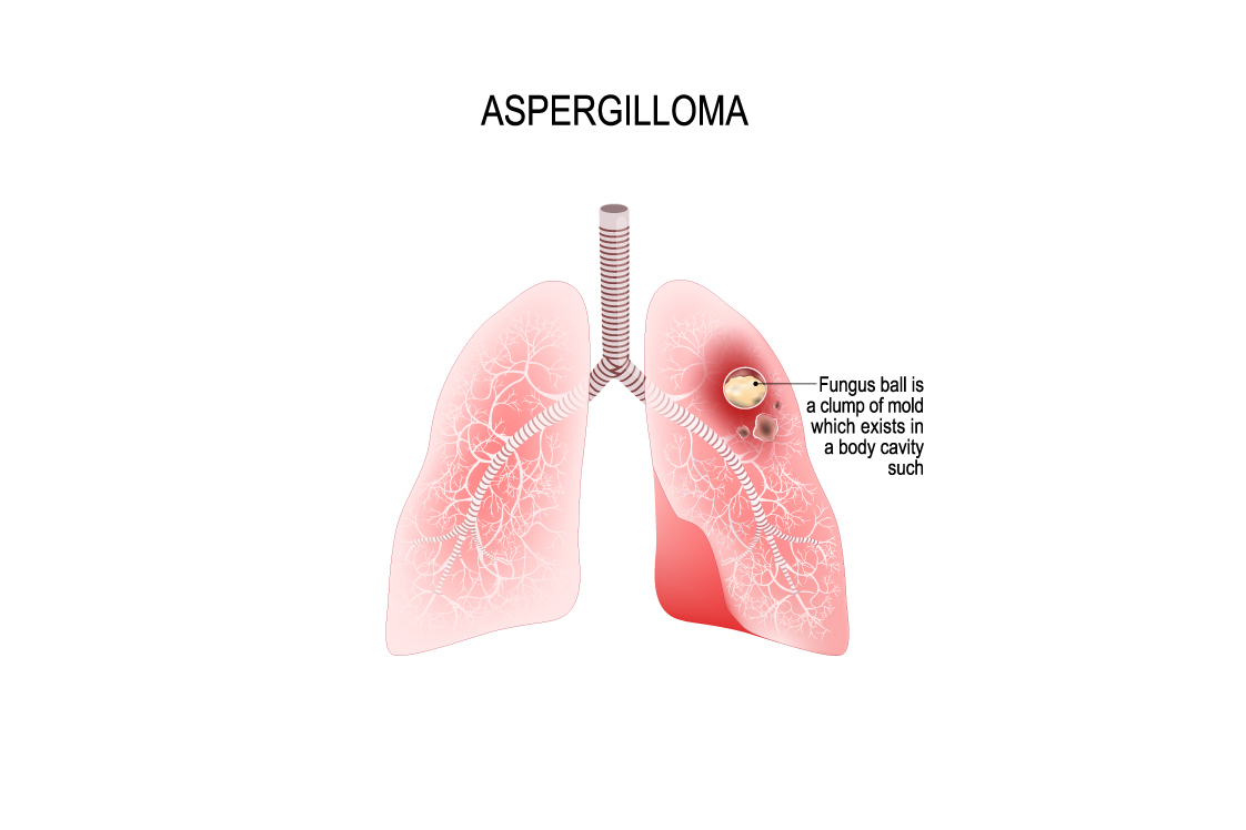 肺真菌症の定義