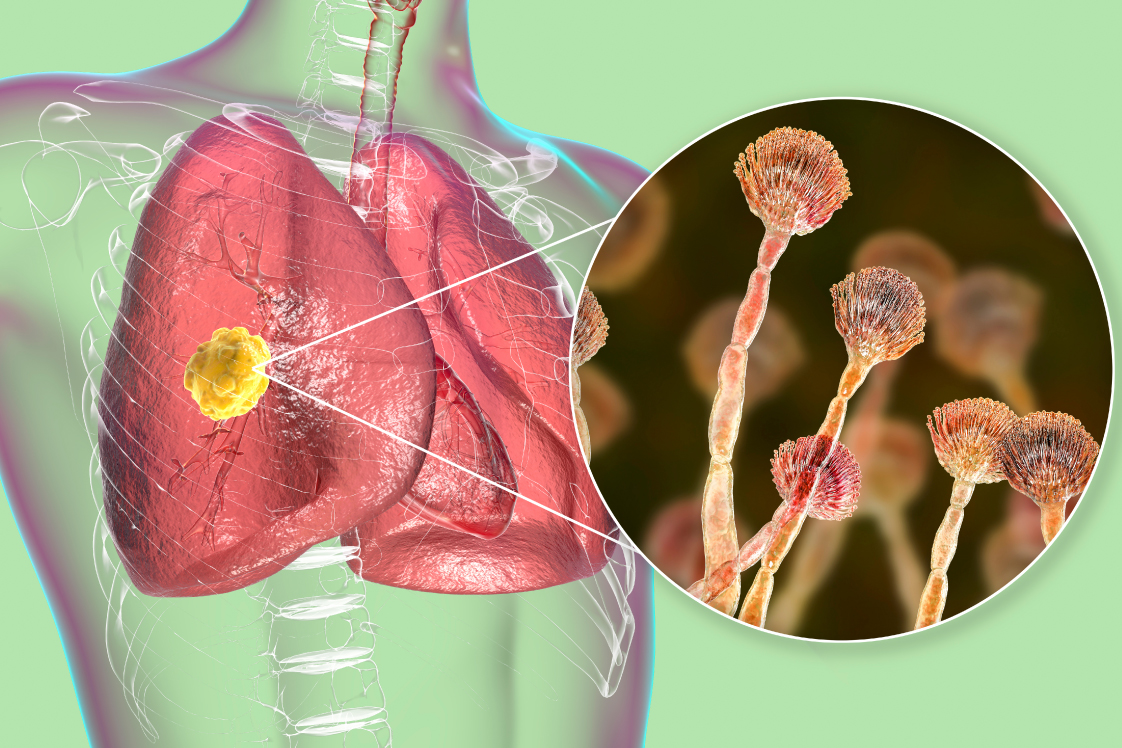 肺真菌症の発症メカニズム
