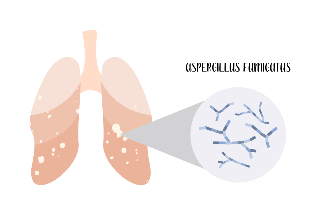 肺アスペルギルス症