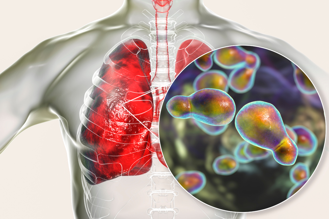 肺クリプトコックス症